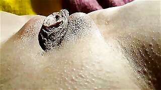 Outer labia inflated